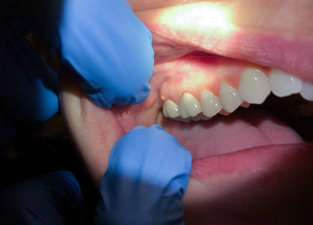Best Emergency Dental Care for Abscessed Tooth in , DC