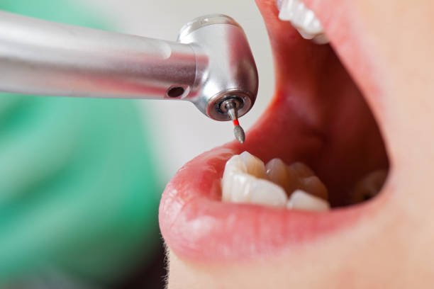Best Emergency Root Canal Treatment in , DC